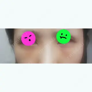 1日目の経過画像（1枚目）