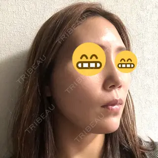 8日目の経過画像（2枚目）