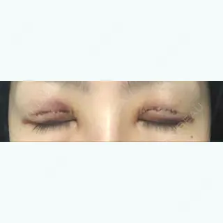 1日目の経過画像（2枚目）