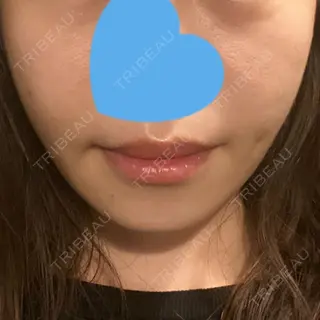 94日目の経過画像（1枚目）