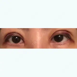 2日目の経過画像（1枚目）