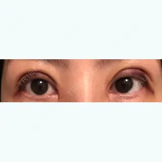 2日目の経過画像（3枚目）