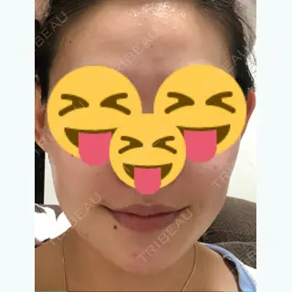 24日目の経過画像（1枚目）