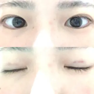 0日目の経過画像（1枚目）