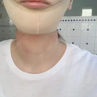 1日目の経過画像（3枚目）