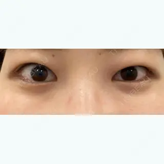 43日目の経過画像（2枚目）