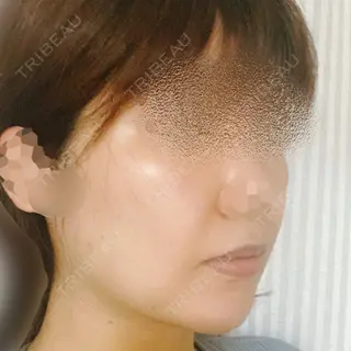 2日目の経過画像（2枚目）