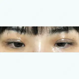 78日目の経過画像（2枚目）