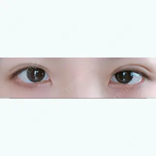 4日目の経過画像（1枚目）