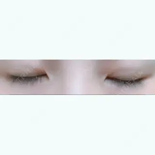 4日目の経過画像（2枚目）