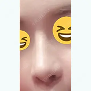 88日目の経過画像（3枚目）