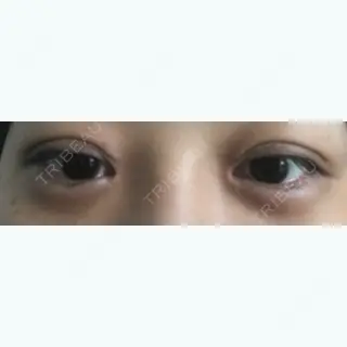 61日目の経過画像（1枚目）