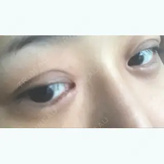 61日目の経過画像（3枚目）