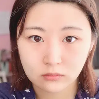 3日目の経過画像（2枚目）