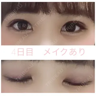 4日目の経過画像（1枚目）