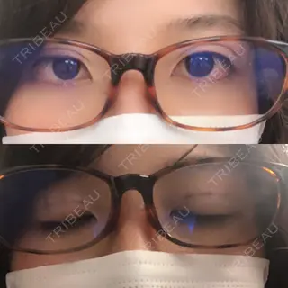0日目の経過画像（1枚目）