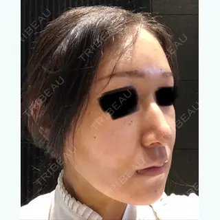 6日目の経過画像（2枚目）