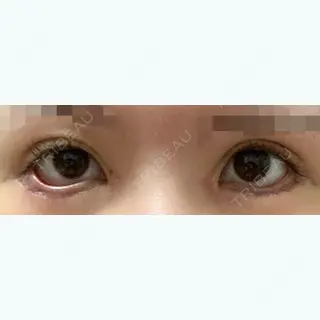 9日目の経過画像（1枚目）
