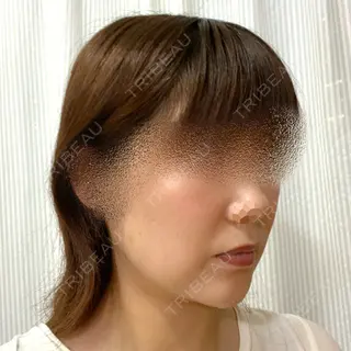 5日目の経過画像（2枚目）