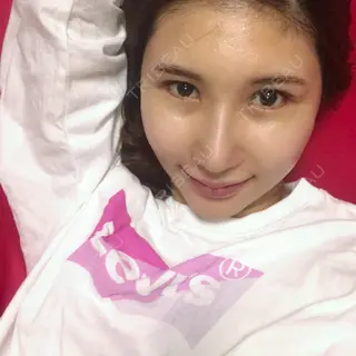 33日目の経過画像（1枚目）