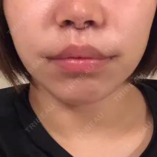 2日目の経過画像（1枚目）