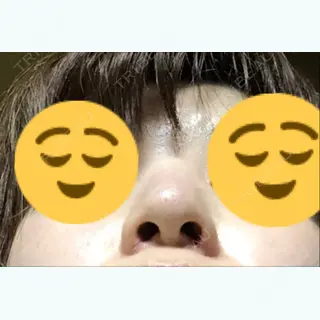 7日目の経過画像（2枚目）