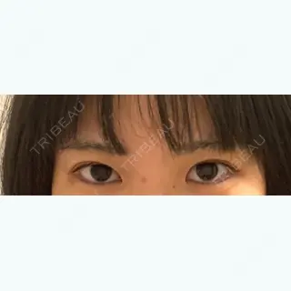 2日目の経過画像（1枚目）