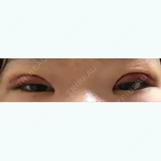 1日目の経過画像（1枚目）