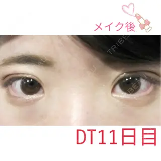 11日目の経過画像（1枚目）