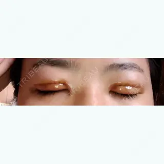 1日目の経過画像（2枚目）