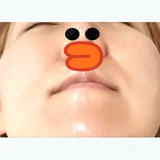 12日目の経過画像（2枚目）