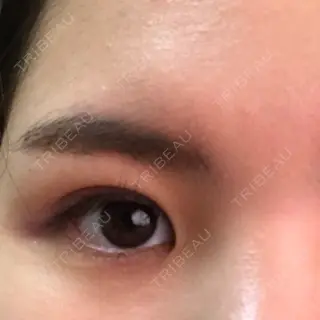 9日目の経過画像（1枚目）