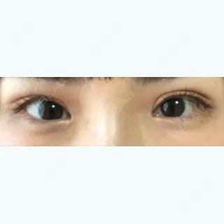 82日目の経過画像（1枚目）