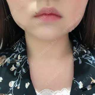 0日目の経過画像（1枚目）