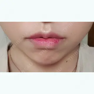0日目の経過画像（1枚目）