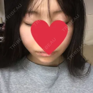 1日目の経過画像（2枚目）