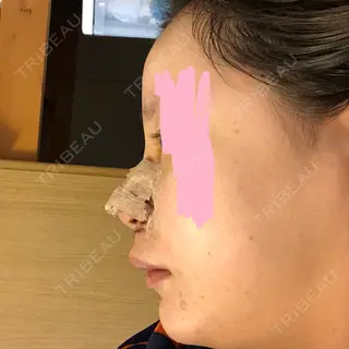 3日目の経過画像（1枚目）
