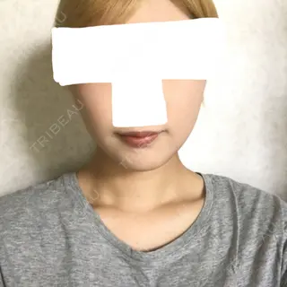 77日目の経過画像（1枚目）