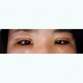 3日目の経過画像（1枚目）