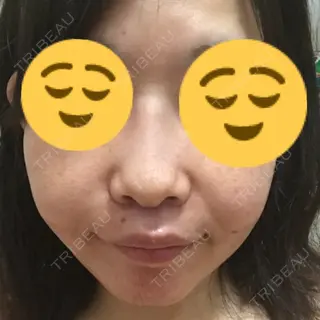 10日目の経過画像（1枚目）