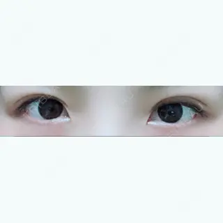 11日目の経過画像（2枚目）
