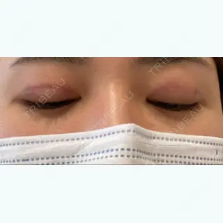 1日目の経過画像（2枚目）
