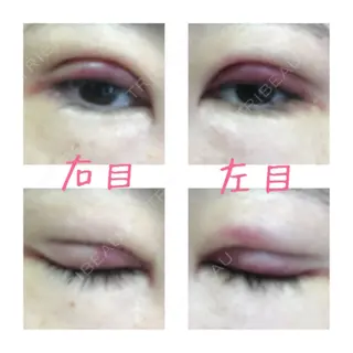 2日目の経過画像（2枚目）
