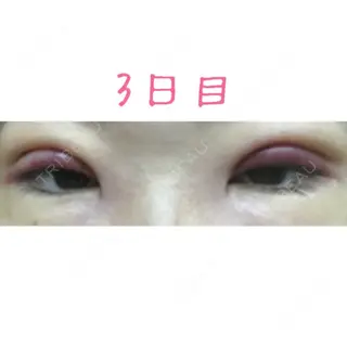 3日目の経過画像（1枚目）