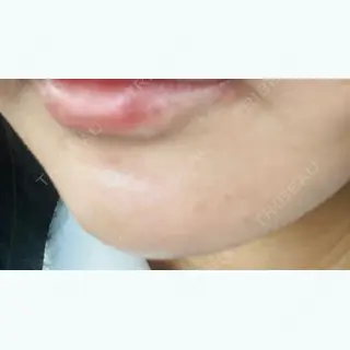 4日目の経過画像（3枚目）