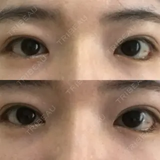 33日目の経過画像（1枚目）