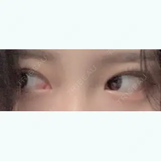 14日目の経過画像（1枚目）