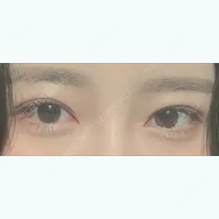 45日目の経過画像（2枚目）