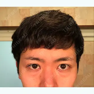 3日目の経過画像（1枚目）