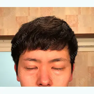 3日目の経過画像（2枚目）